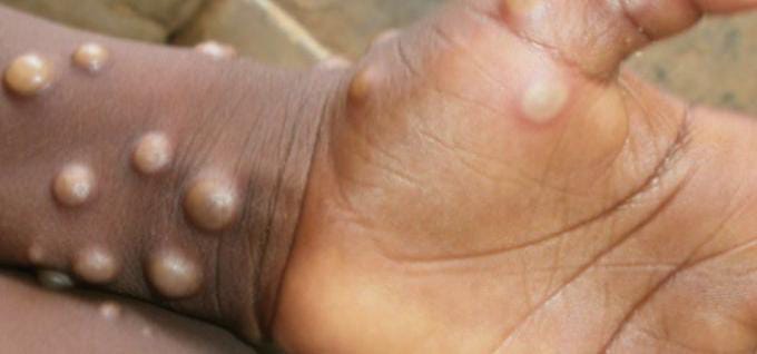 Monkey pox in Telangana: தெலுங்கானாவில் குரங்கு அம்மை தொற்றால் ஒருவர் பாதிப்பு