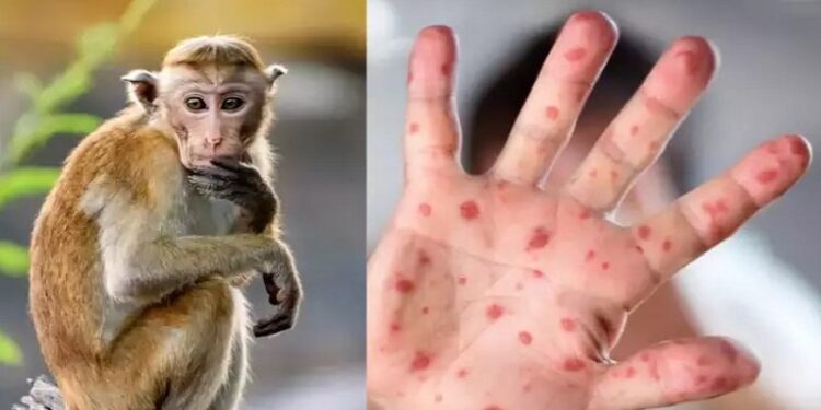 Monkey pox In Kerala : கேரள மாநிலத்தில் இரண்டாவதாக மேலும் ஒருவருக்கு குரங்கு அம்மை பாதிப்பு