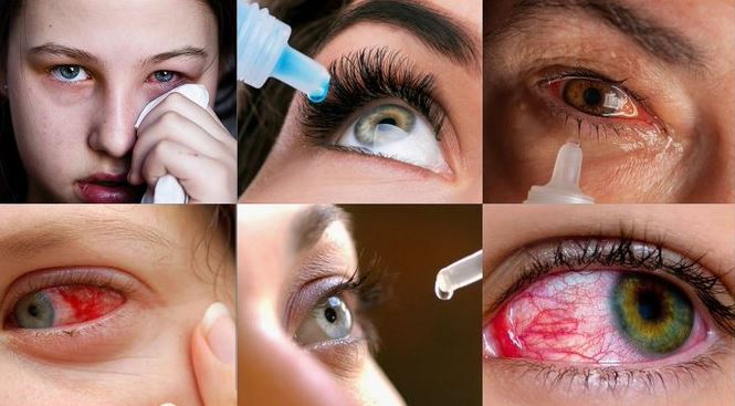 symptoms and mechanisms of Madras eye: வேகமாக பரவிவரும் மெட்ராஸ் ஐ: அறிகுறிகளும் வழிமுறைகளும்